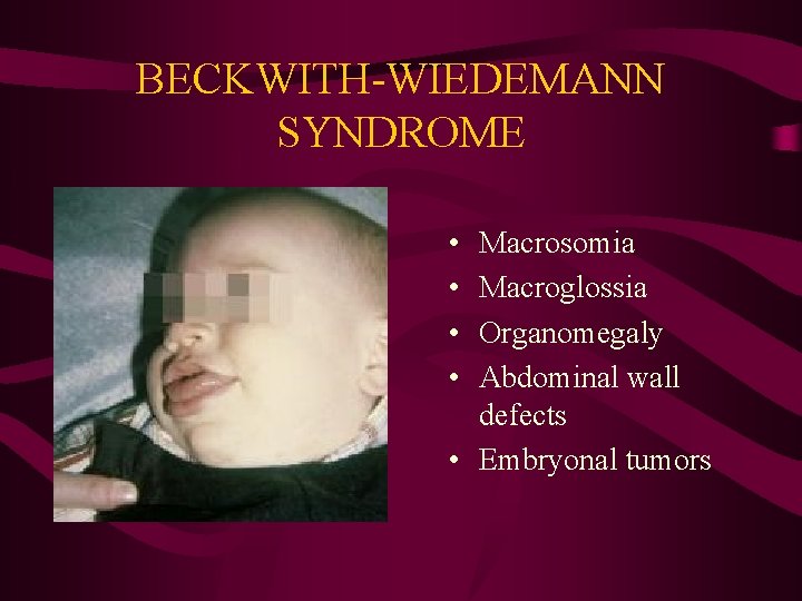 BECKWITH-WIEDEMANN SYNDROME • • Macrosomia Macroglossia Organomegaly Abdominal wall defects • Embryonal tumors 