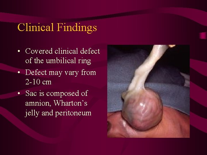 Clinical Findings • Covered clinical defect of the umbilical ring • Defect may vary