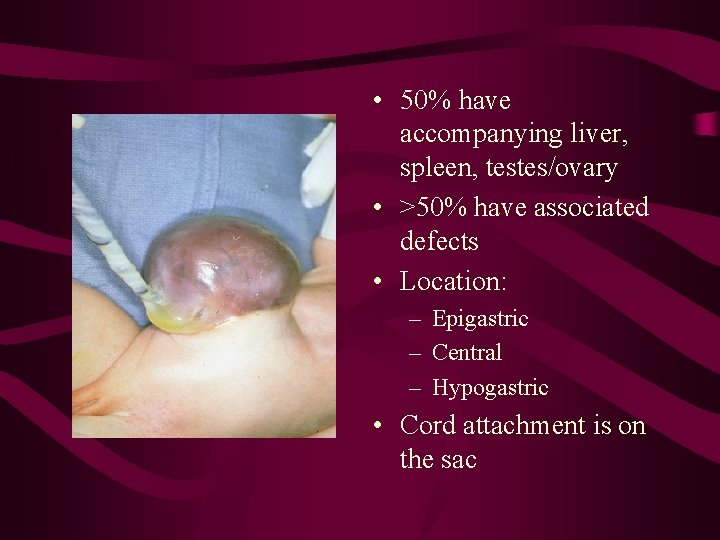  • 50% have accompanying liver, spleen, testes/ovary • >50% have associated defects •