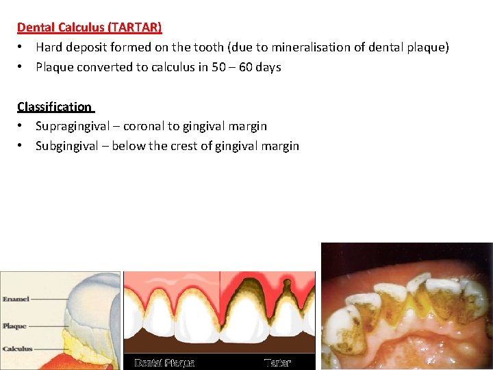 Dental Calculus (TARTAR) • Hard deposit formed on the tooth (due to mineralisation of