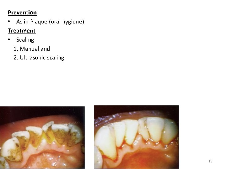 Prevention • As in Plaque (oral hygiene) Treatment • Scaling 1. Manual and 2.