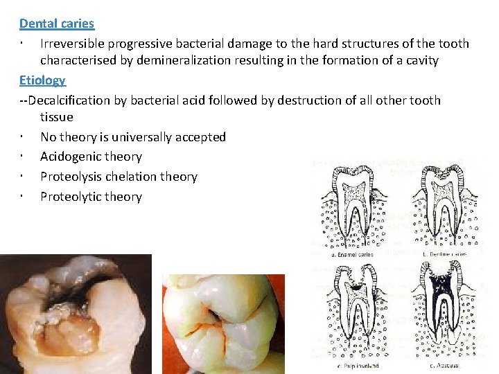 Dental caries Irreversible progressive bacterial damage to the hard structures of the tooth characterised