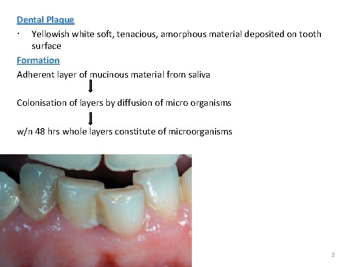 Dental Plaque Yellowish white soft, tenacious, amorphous material deposited on tooth surface Formation Adherent