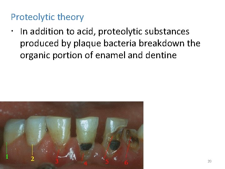 Proteolytic theory In addition to acid, proteolytic substances produced by plaque bacteria breakdown the