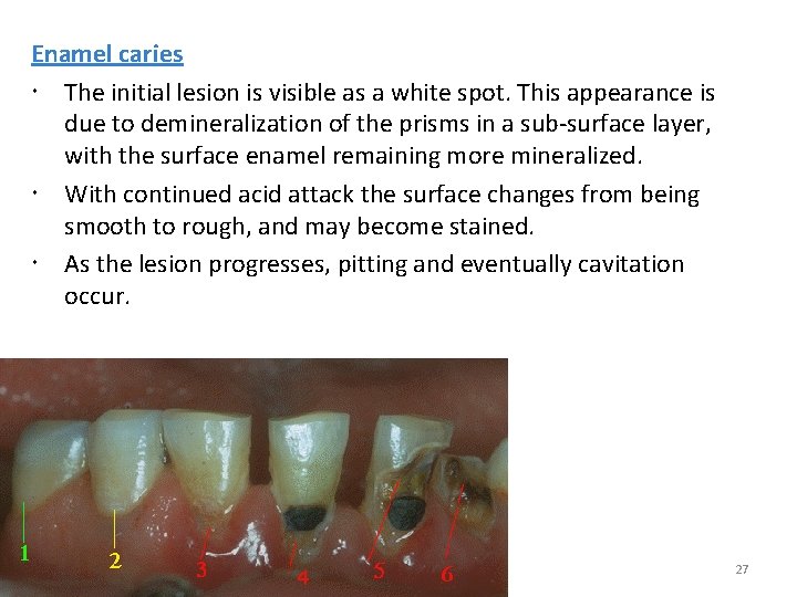 Enamel caries The initial lesion is visible as a white spot. This appearance is