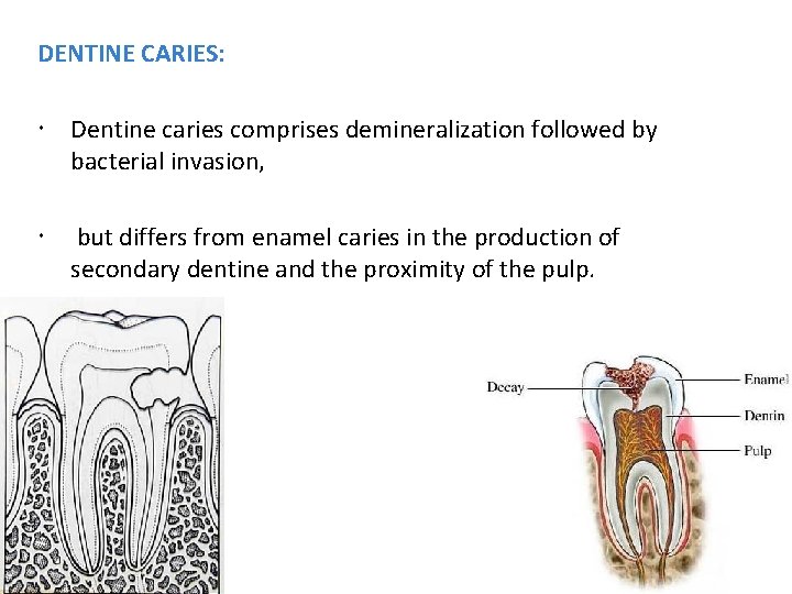 DENTINE CARIES: Dentine caries comprises demineralization followed by bacterial invasion, but differs from enamel
