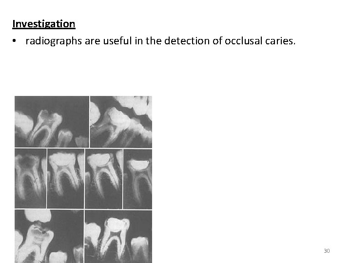 Investigation • radiographs are useful in the detection of occlusal caries. 30 
