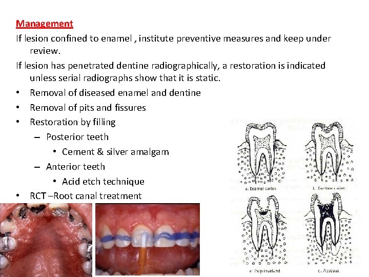 Management If lesion confined to enamel , institute preventive measures and keep under review.