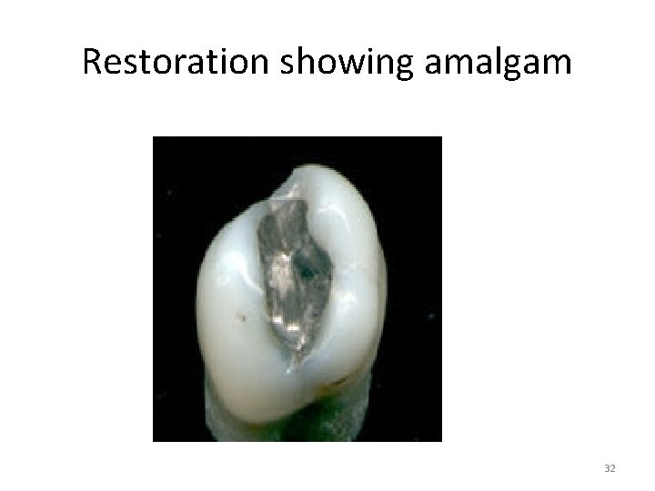 Restoration showing amalgam 32 