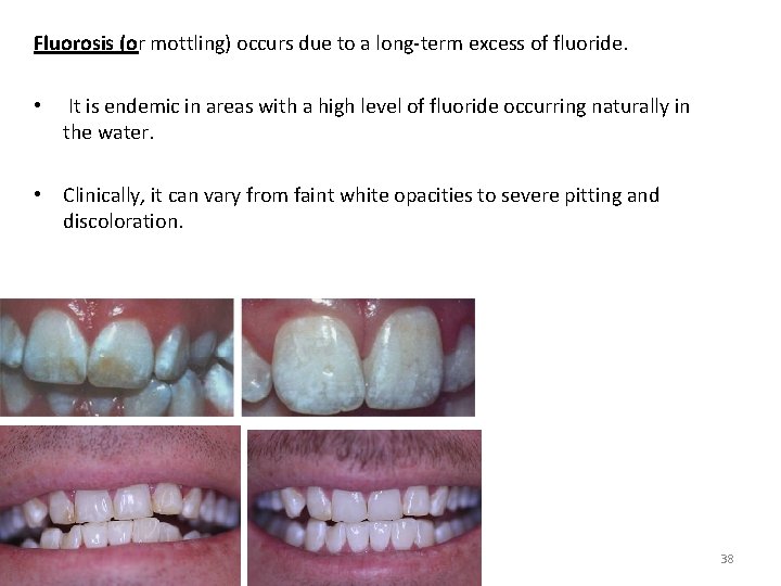 Fluorosis (or mottling) occurs due to a long-term excess of fluoride. • It is