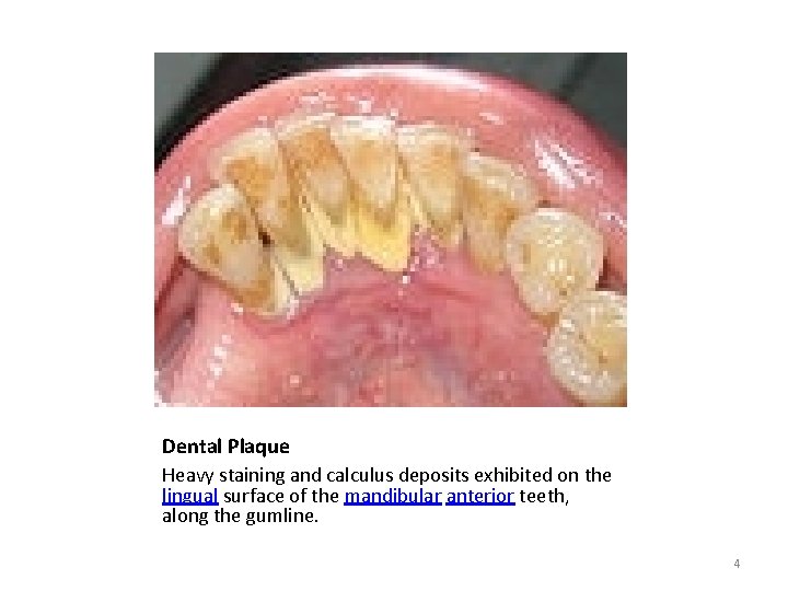 Dental Plaque Heavy staining and calculus deposits exhibited on the lingual surface of the