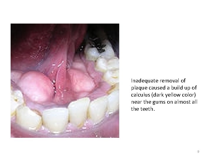 Inadequate removal of plaque caused a build up of calculus (dark yellow color) near