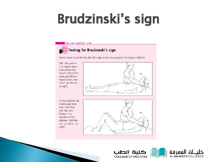 Brudzinski’s sign 