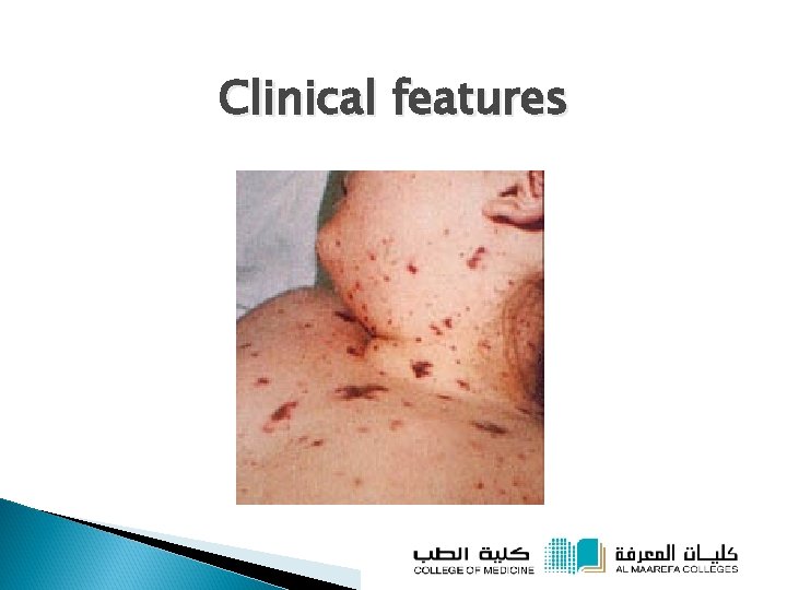 Clinical features 