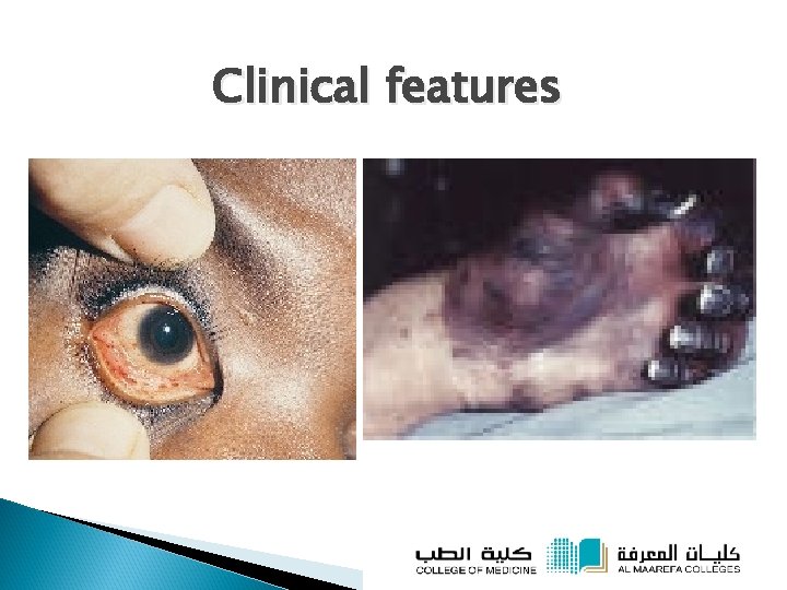 Clinical features 