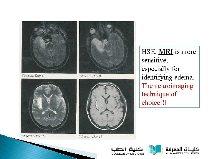 HSE: MRI is more sensitive, especially for identifying edema. The neuroimaging technique of choice!!!