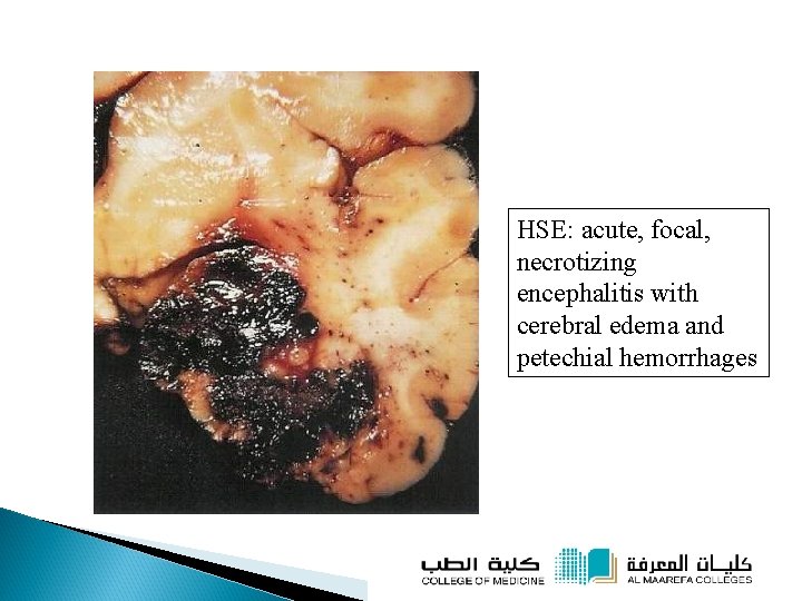 HSE: acute, focal, necrotizing encephalitis with cerebral edema and petechial hemorrhages 