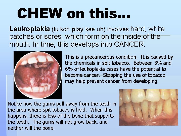 CHEW on this… Leukoplakia (lu koh play kee uh) involves hard, white patches or