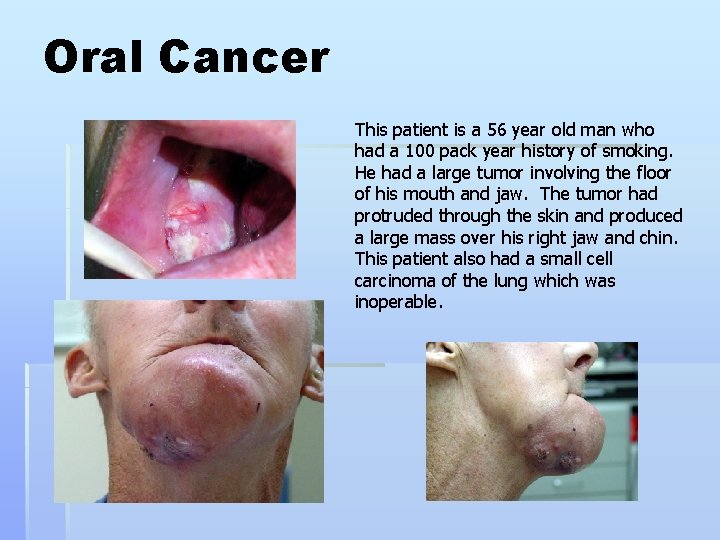 Oral Cancer This patient is a 56 year old man who had a 100