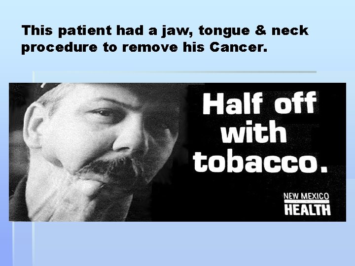 This patient had a jaw, tongue & neck procedure to remove his Cancer. 