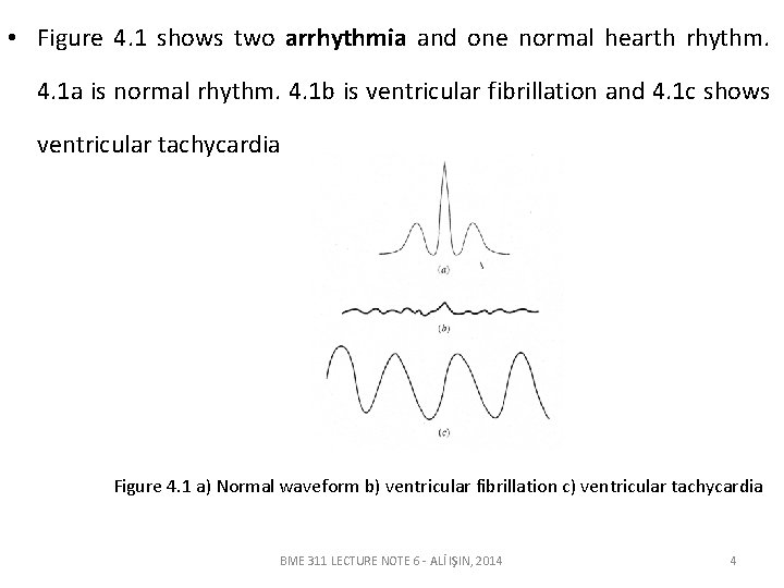  • Figure 4. 1 shows two arrhythmia and one normal hearth rhythm. 4.