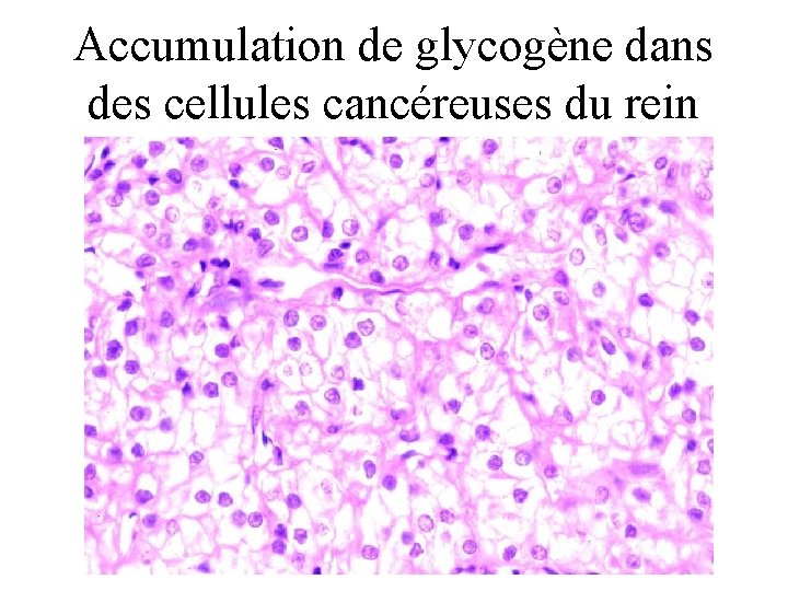 Accumulation de glycogène dans des cellules cancéreuses du rein 