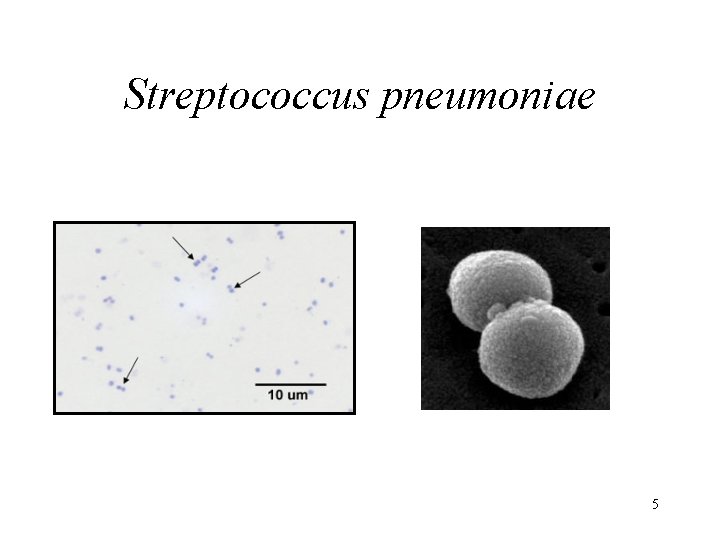 Streptococcus pneumoniae 5 