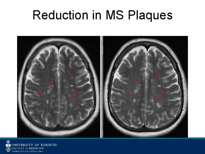 Reduction in MS Plaques 