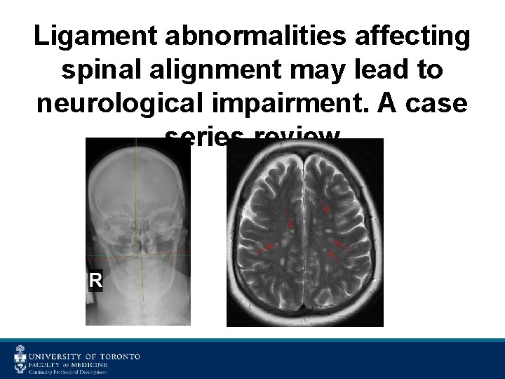 Ligament abnormalities affecting spinal alignment may lead to neurological impairment. A case series review