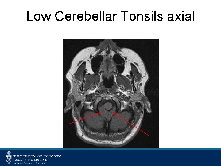 Low Cerebellar Tonsils axial 