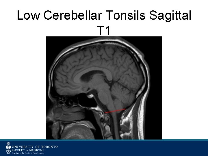 Low Cerebellar Tonsils Sagittal T 1 