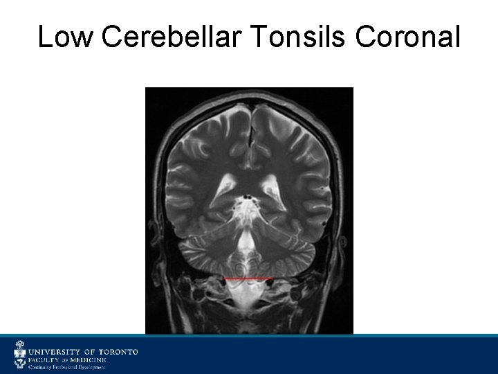 Low Cerebellar Tonsils Coronal 
