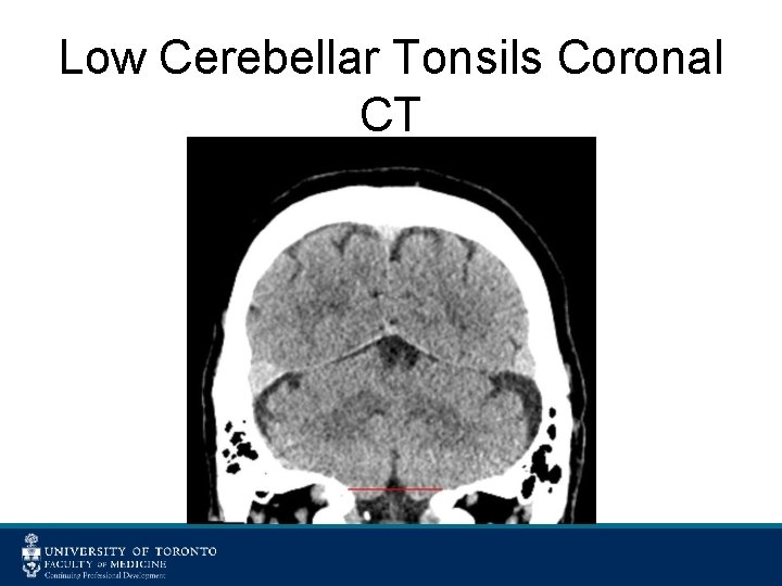 Low Cerebellar Tonsils Coronal CT 