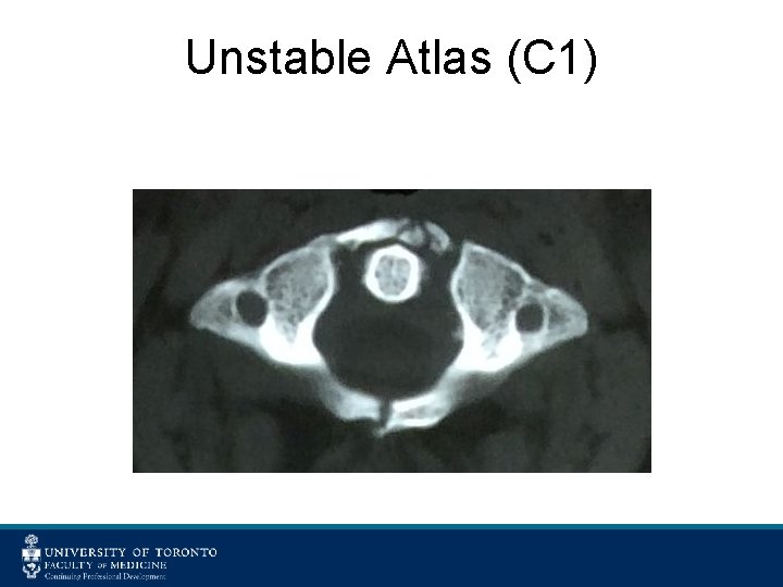 Unstable Atlas (C 1) 