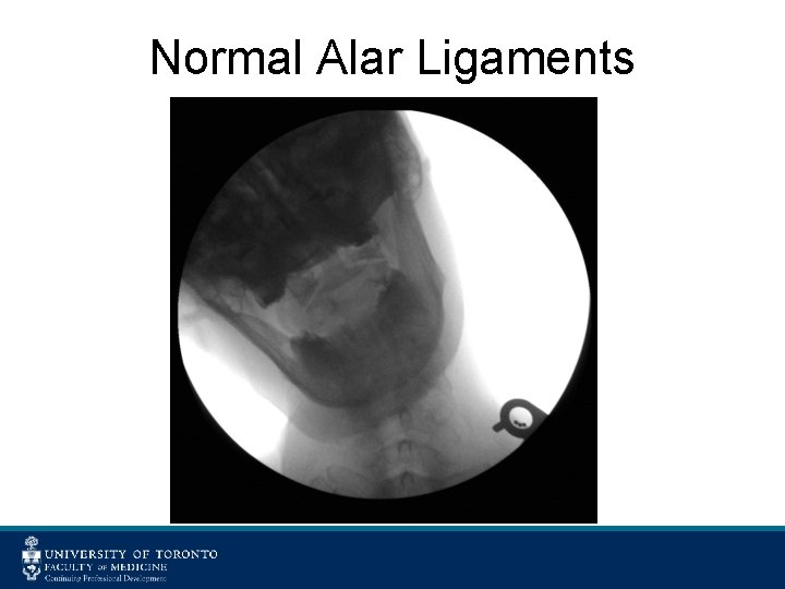 Normal Alar Ligaments 