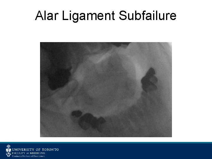 Alar Ligament Subfailure 