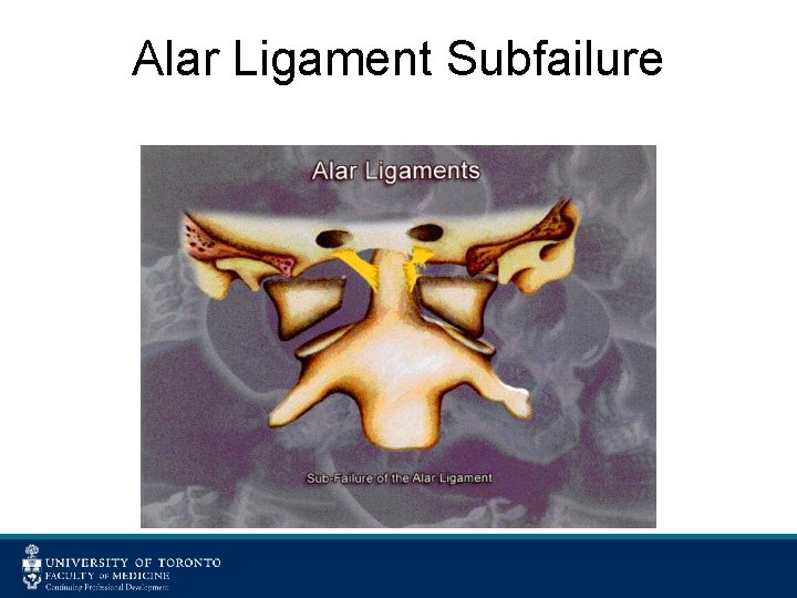 Alar Ligament Subfailure 
