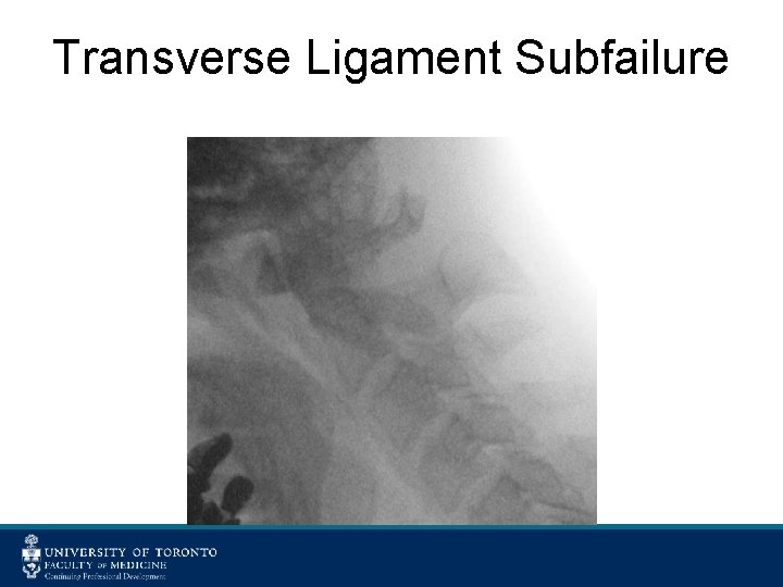 Transverse Ligament Subfailure 