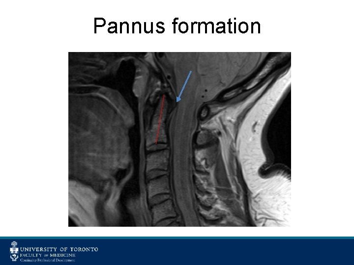 Pannus formation 