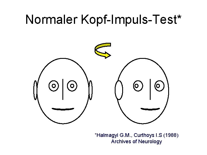 Normaler Kopf-Impuls-Test* *Halmagyi G. M. , Curthoys I. S (1988) Archives of Neurology 