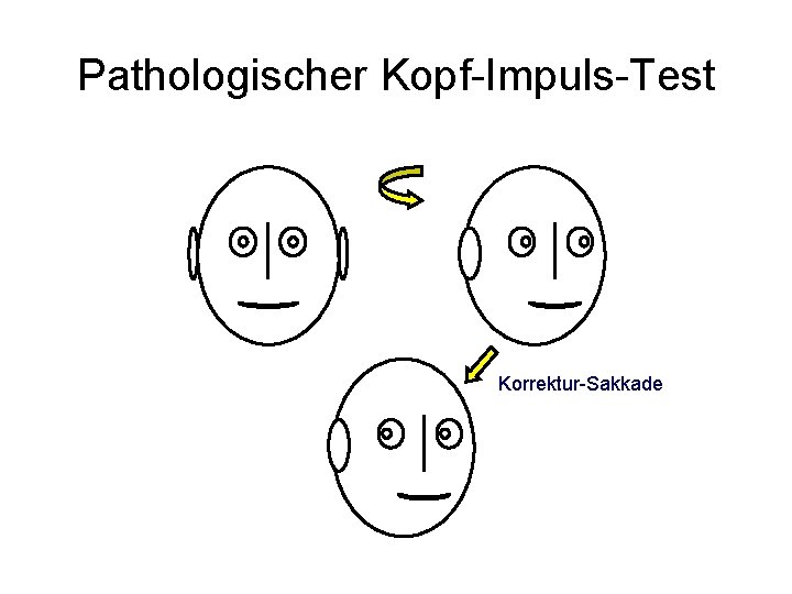 Pathologischer Kopf-Impuls-Test Korrektur-Sakkade 