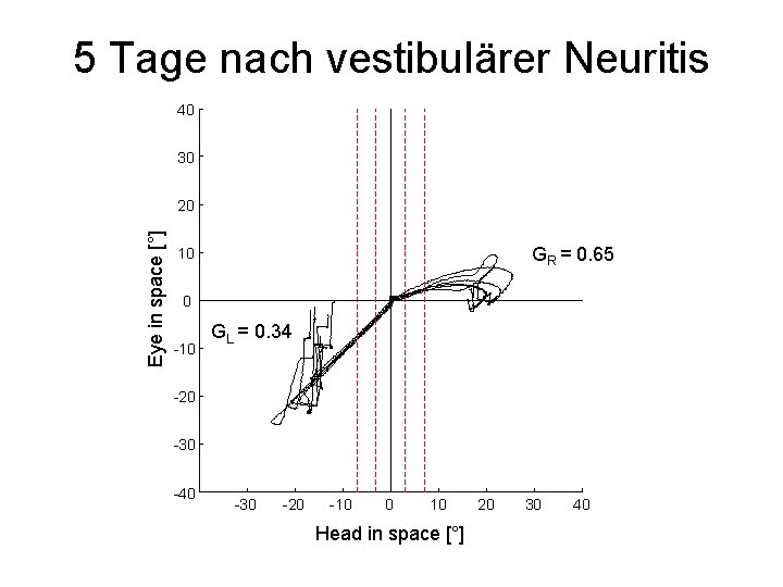 5 Tage nach vestibulärer Neuritis 40 30 Eye in space [°] 20 GR =