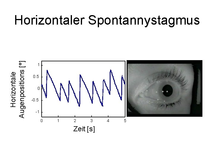 Horizontale Augenpositions [°] Horizontaler Spontannystagmus 1 0. 5 0 -0. 5 -1 0 1