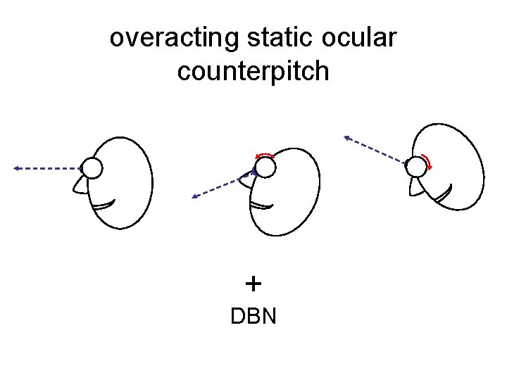 overacting static ocular counterpitch + DBN 