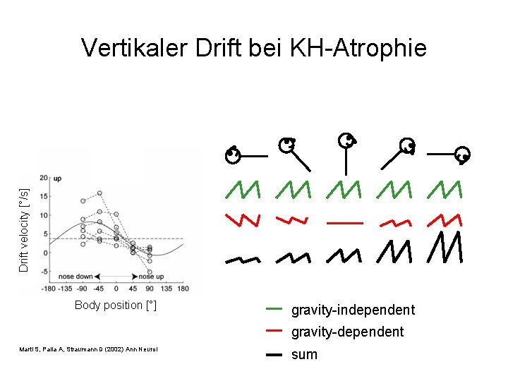 Drift velocity [°/s] Vertikaler Drift bei KH-Atrophie Body position [°] gravity-independent gravity-dependent Marti S,