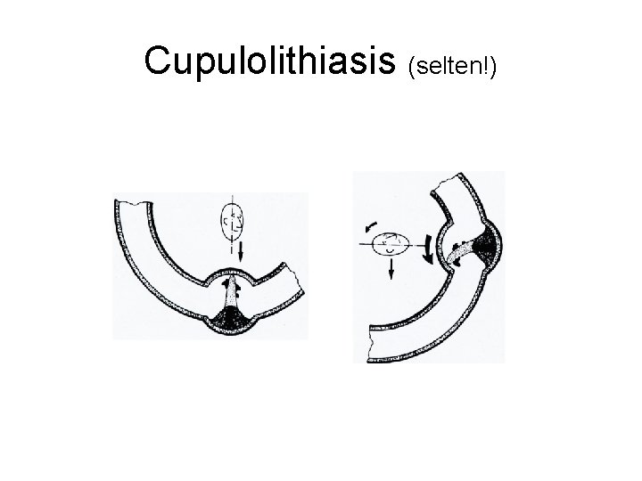 Cupulolithiasis (selten!) 