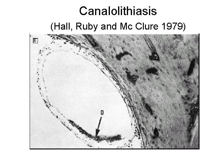 Canalolithiasis (Hall, Ruby and Mc Clure 1979) 