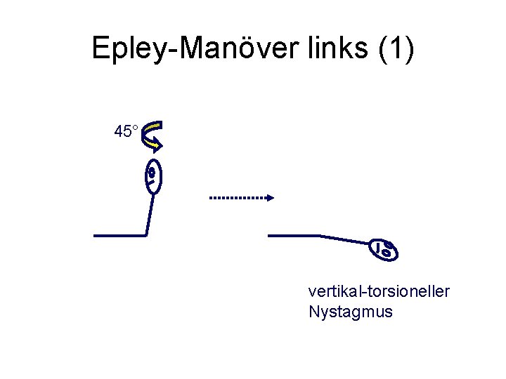 Epley-Manöver links (1) 45° vertikal-torsioneller Nystagmus 