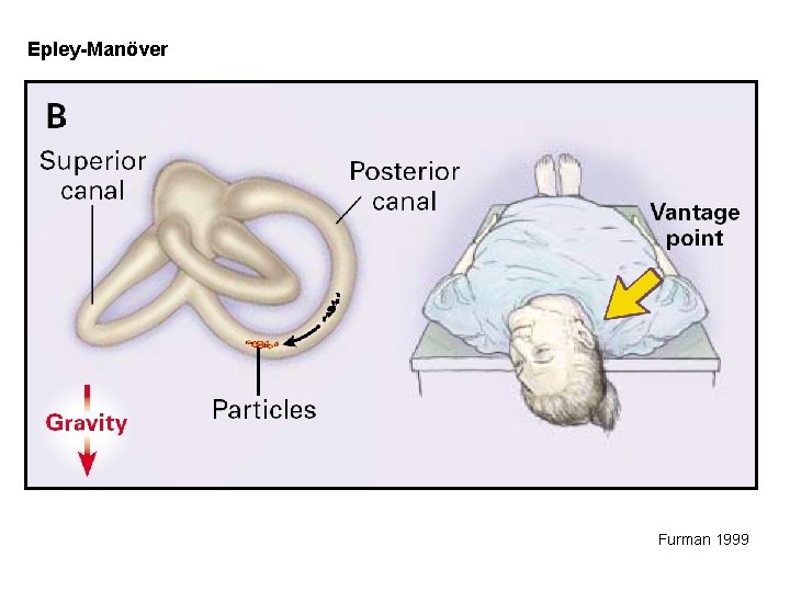 Epley-Manöver Furman 1999 
