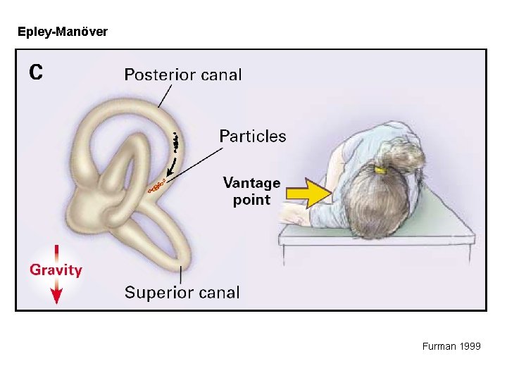 Epley-Manöver Furman 1999 